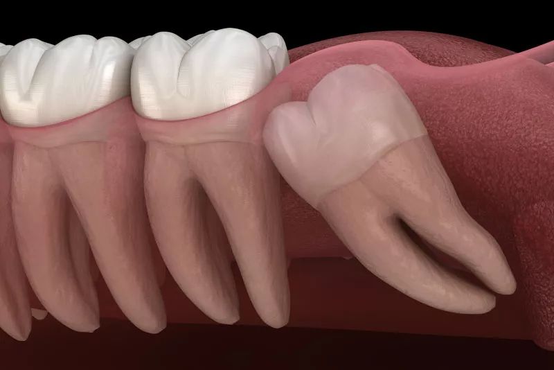 wisdom teeth